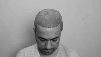 FUE Hair Transplant