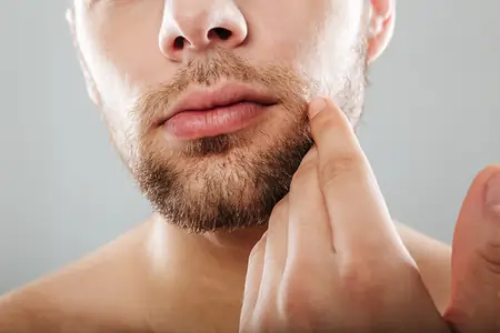 Mole And Wart Removal
